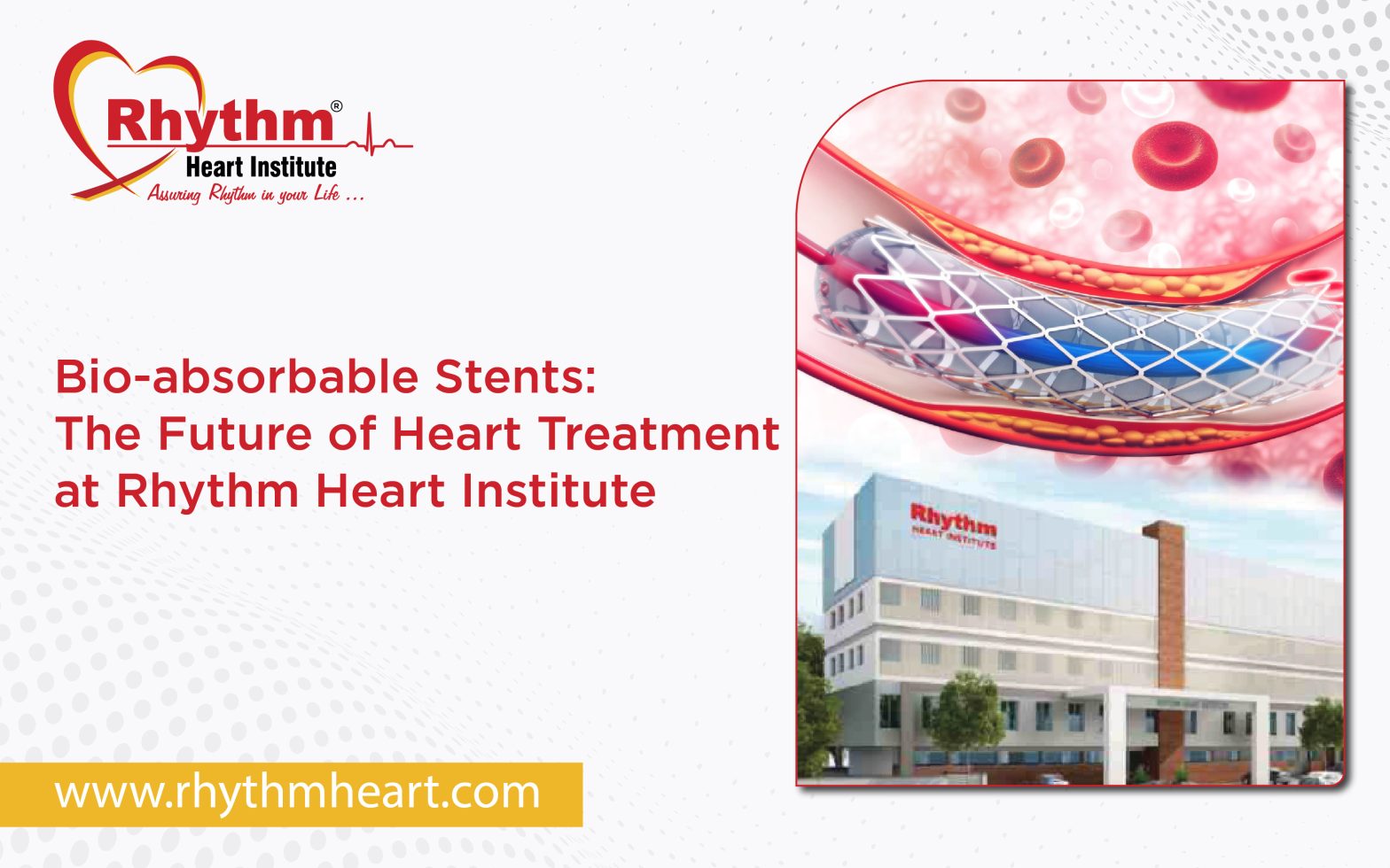Bio-absorbable stent used in advanced heart treatment